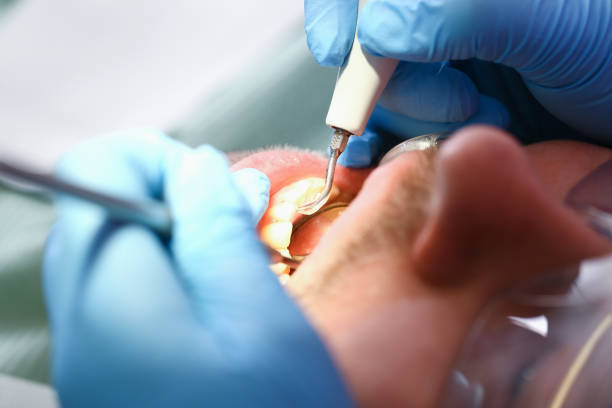 Best Emergency Dentist for Knocked-Out Tooth in Dover, TN