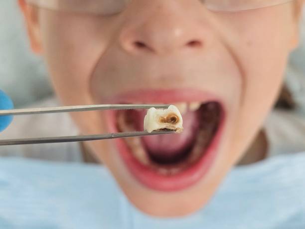 Best Emergency Dental Extractions in Dover, TN