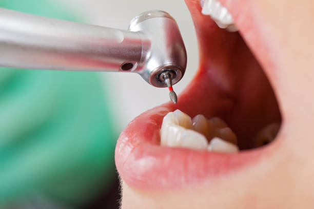Best Emergency Dentist for Lost Fillings or Crowns in Dover, TN